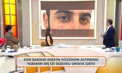 Canlı yayında Enes Güran’ın gözünün altındaki diş izine dikkat çekildi