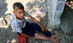 Kaza sonrası ayağı yanlış kaynadı, hayatı kaykay üzerinde geçiyor