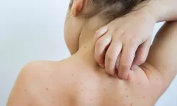 Uzmanlardan suçiçeği uyarısı