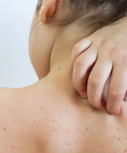 Uzmanlardan suçiçeği uyarısı