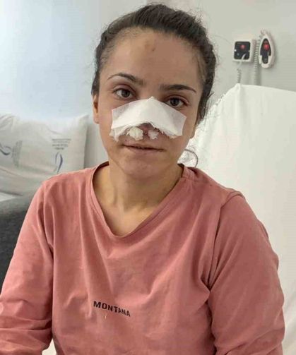 Eşinin kopardığı burnu başarılı operasyonla yerine dikildi