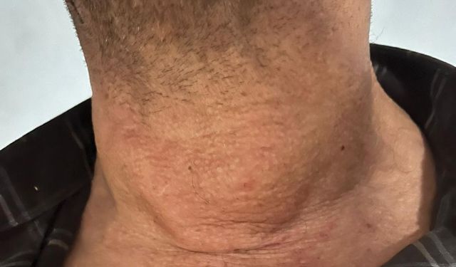 Kütahya’da dev guatr ameliyatsız tedavi edildi: Yüzde 90’dan fazla küçülme oldu