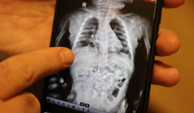 Doğuştan 200 binde bir görülen hastalıkla 2 yıl boyunca yaşayan çocuk sağlığına kavuştu