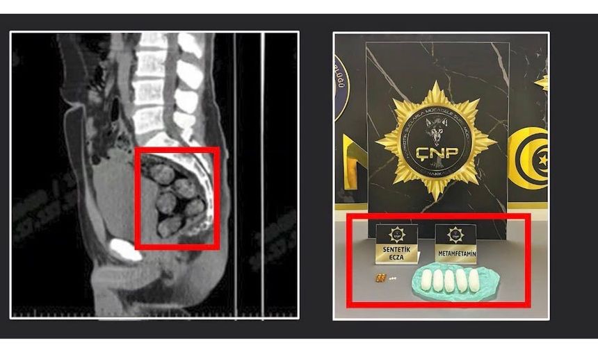 Tomografide şok eden görüntü...Uyuşturucu midesinden çıkarıldı