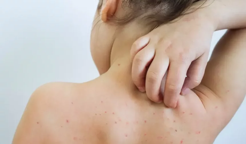 Uzmanlardan suçiçeği uyarısı